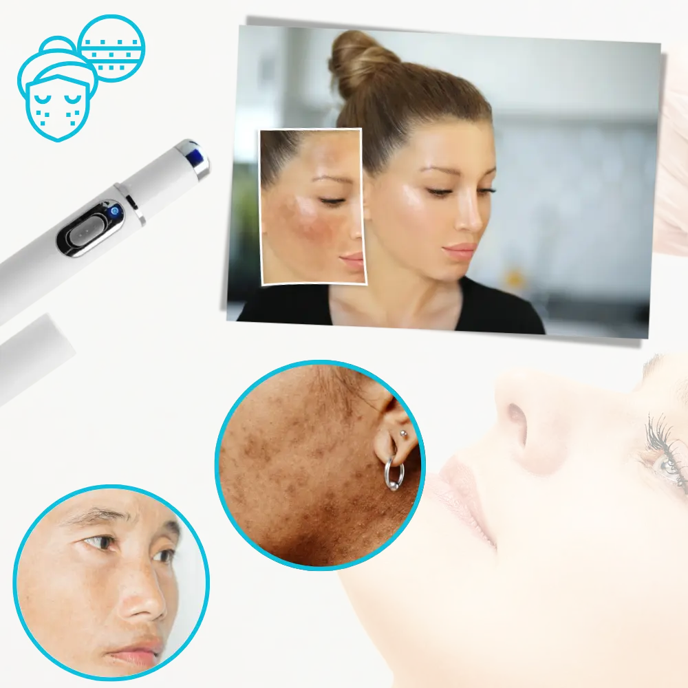 Dark Spot Remover Blue Laser Pen - Zoozto