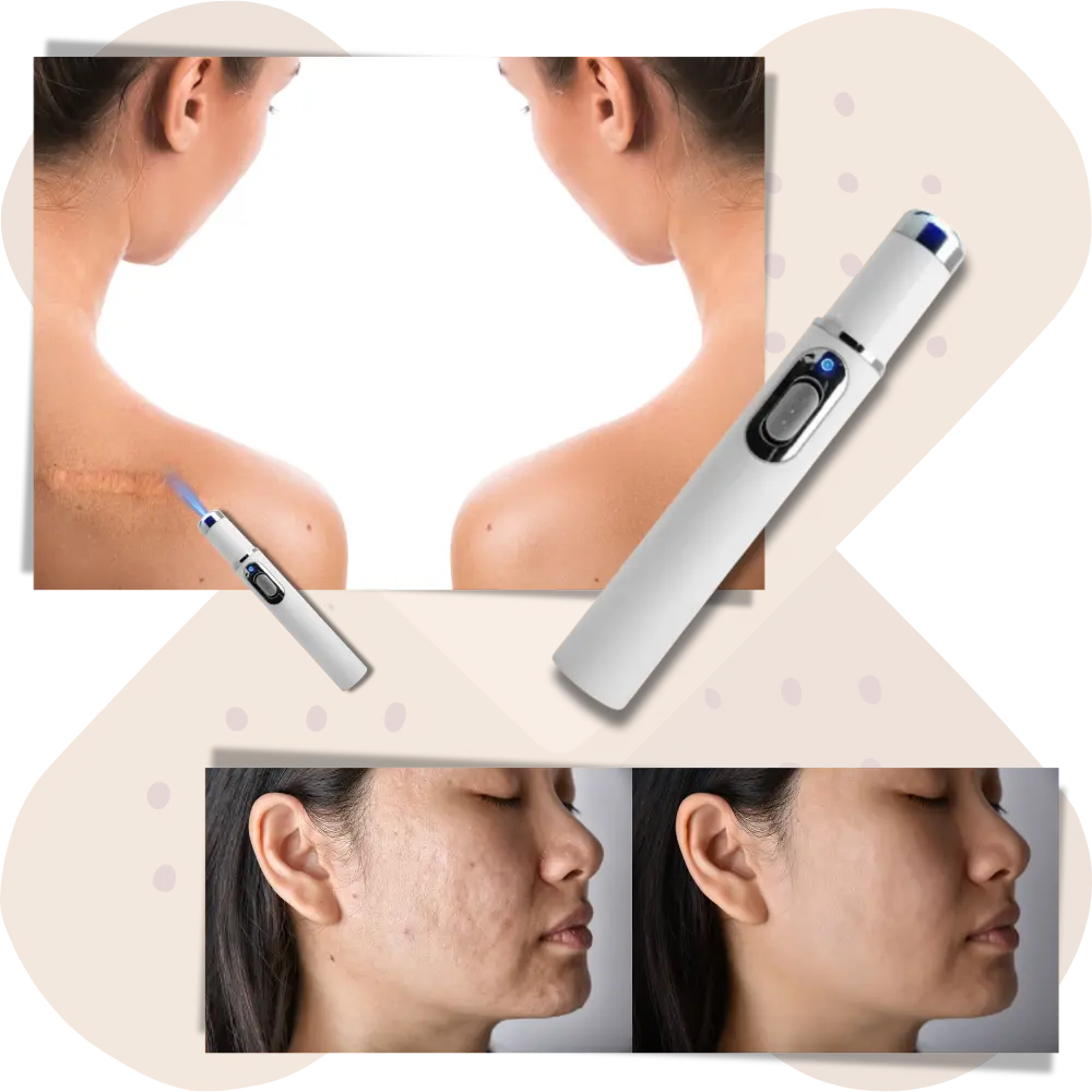 Dark Spot Remover Blue Laser Pen - Zoozto