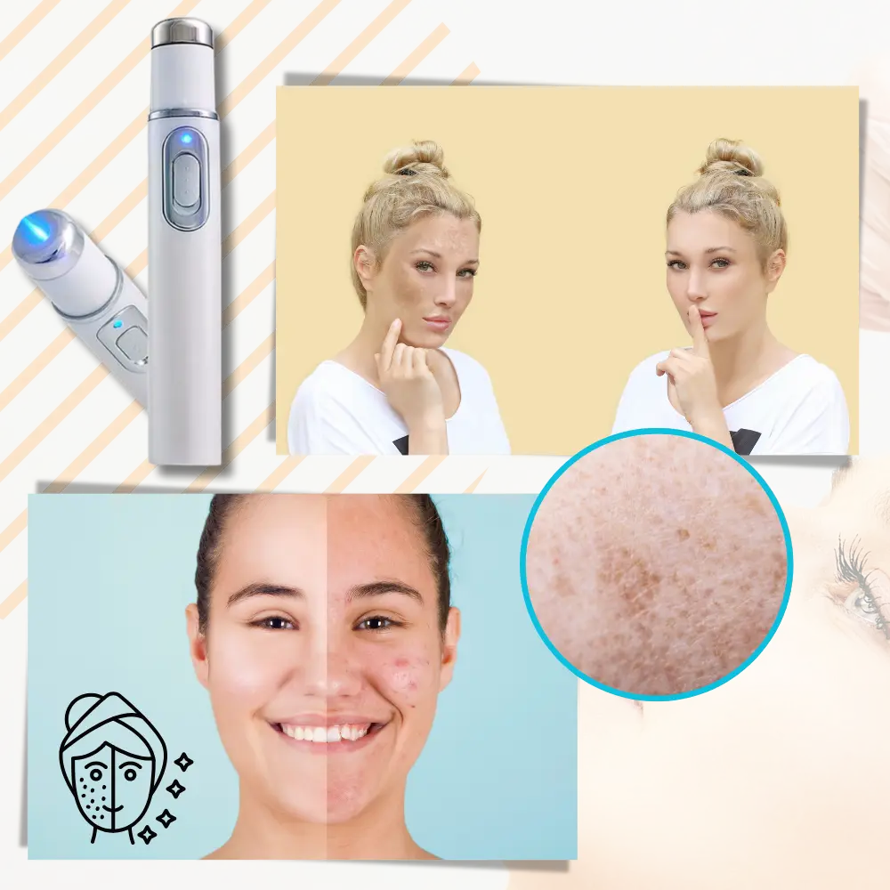 Dark Spot Remover Blue Laser Pen - Zoozto